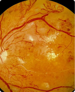 Donate for Diabetic Retinopathy Treatment